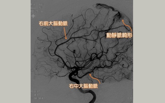 動脈畸形患者因腦內微血管發育不全，腦部動、靜脈交會處有不正常的畸形組織，使動脈直接注入靜脈。