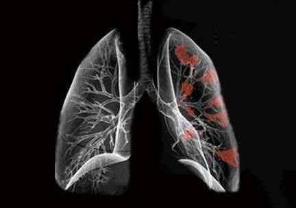 如何挽救晚期肺癌患者 ảnh 1