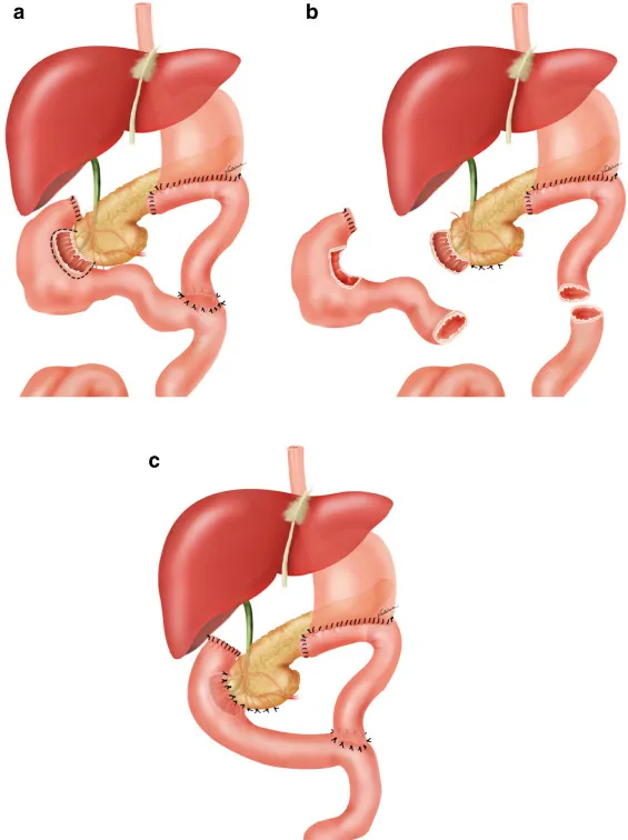Hình minh họa kỹ thuật phẫu thuật giãn tá tràng.jpeg