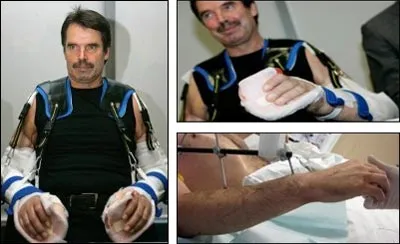 Bệnh nhân ghép hai cánh tay tay đầu tiên trên thế giới tỏ lạc quan