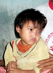 Cháu bé 4 tuổi bị ung thư võng mạc
