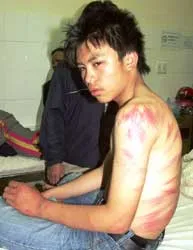 Đi học trễ… bị thầy giáo đánh phải nhập viện