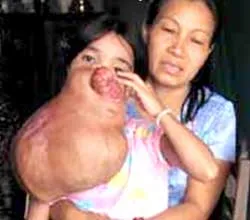 Mỹ phẫu thuật bướu cho em Đào Thị Lai