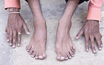 Tự hào vì có 12 ngón tay và 14 ngón chân ảnh 2