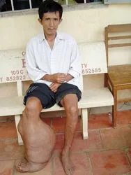 Anh Ngô Minh Thành mong được giúp đỡ để phẫu thuật chân