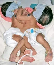 Mổ tách thành công ca song sinh dính nhau nhỏ nhất