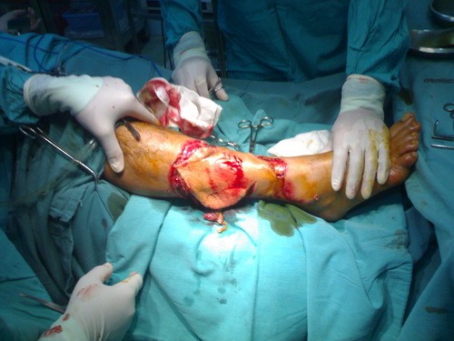 Doctors perform surgery on the leg of Nguyen Quang Vinh, the first of around 20 victims to be attacked by an unidentified marine animal in waters off the central coast. Vinh was attacked on September 18, 2009. (Photo: Tuoi Tre)