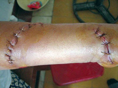 Nguyen Minh Tuan has his arm badly bitten January 9 by an unknown fish while swimming off the central coast. Experts have now identified the fish as selachium ( Photo: Thanh Nien)