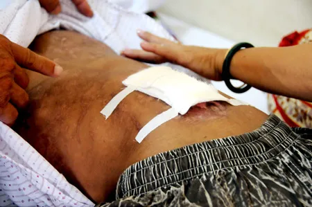 Những vết sẹo chi chít trên lưng và những vết phỏng chưa lành do chế nước sôi nhiều lần trên lưng cháu Hào Anh đã tố cáo sự tàn ác của vợ chồng chủ trại tôm (ảnh chụp chiều 12-5). Ảnh: Thái Bằng