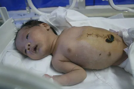 Cứu sống một trẻ sơ sinh thủng ruột trong bụng mẹ