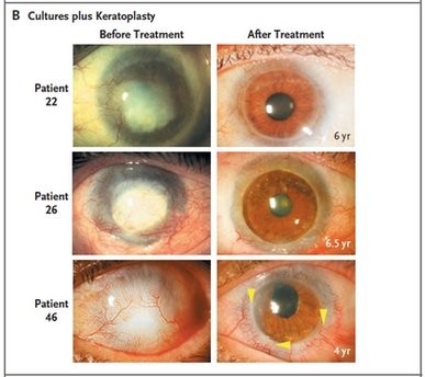 This image from an Italian study published online Wednesday, June 23, 2010 by the New England Journal of Medicine shows the eyes of three patients with alkali burns before and after successful stem cell transplants.