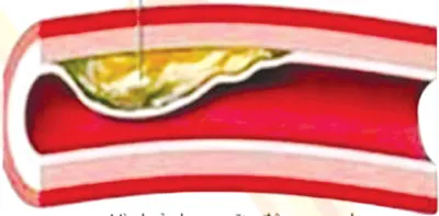 Mỡ máu cao - Sát Thủ Thầm Lặng