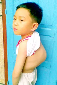 Cháu bé bị bệnh tim bẩm sinh, vẹo cột sống