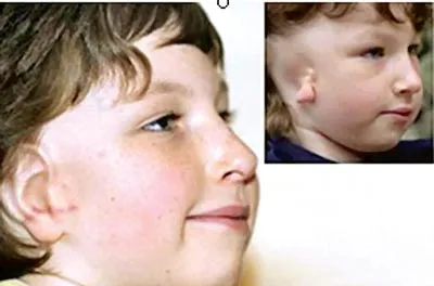 Gắn tai cho cậu bé không tai