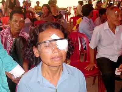 A poor Cambodian woman after eye surgery (Photo: SGGP)