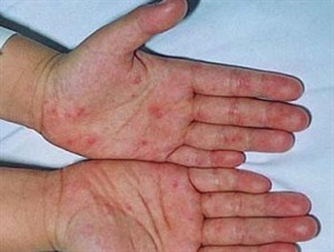 Symptoms of hand-foot-mouth disease on a child’s hand