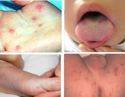 Some symptoms of the HFM disease