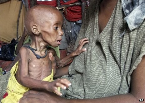 A refugee camp in Mogadishu has been sheltering this severely malnourished child from southern Somalia