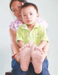 Đôi chân bé Hồ Nguyễn Hoàng Tiến đang bong tróc lớp sừng đen và phục hồi làn da