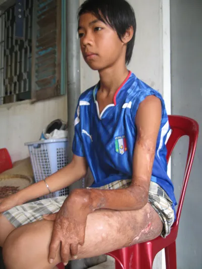 Xin giúp em Mẫn phẫu thuật tay