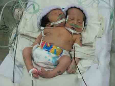 The conjoined twins in the Pediatric Hospital No.1 in Ho Chi Minh City (Photo: SGGP)
