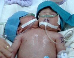 The conjoined twins are under medical care of Pediatric Hospital 1.