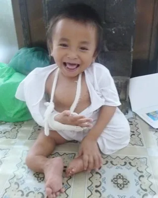 Thăm các bé bị bệnh xương thủy tinh