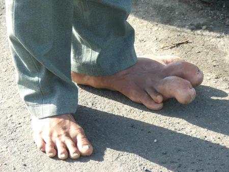 Anh Tài với "bàn chân voi"