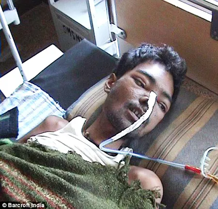 Bệnh nhân Singh tại bệnh viện ở bang Chhattisgarh, Ấn Độ