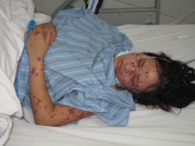 A female patient suffering from the brain inflammatory disease (Photo: Dan Tri))