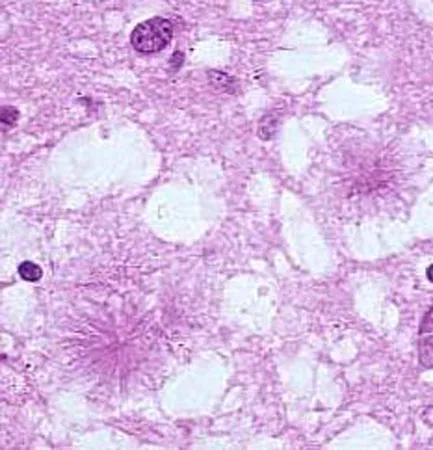 Thành công trong việc xét nghiệm máu phát hiện mầm bệnh bò điên ở  Anh