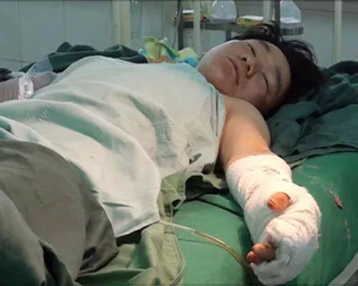 Nối bàn tay sau 5 giờ bị đứt lìa