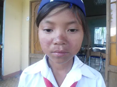 Quảng Ngãi: Thêm một bệnh “lạ” xuất hiện