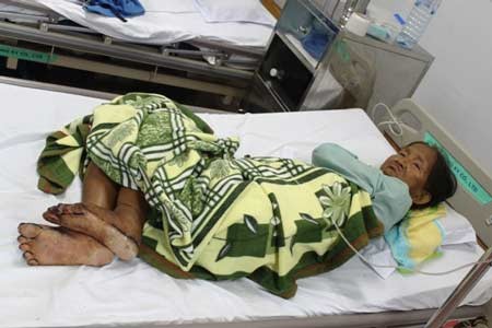 A patient suffering from the unknown and bizarre skin disease being treated in district medical center
