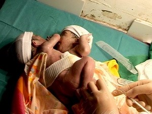 Conjoined twins, Dam Thi Thu A and Dam Thi Thu B, before the separation surgery
