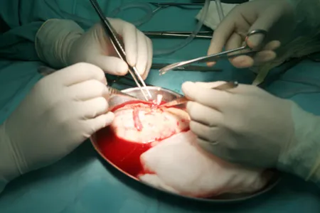 Thực hiện thành công ca ghép  thận cho bệnh nhân bị cắt nhầm thận  ở Cần Thơ