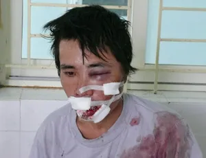 Thanh Hóa: Nhiều đối tượng trộm chó bị đánh thương vong