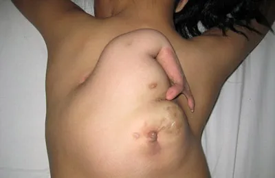 Trung Quốc: Thành công trong việc phẫu thuật cắt bỏ cánh tay thứ ba mọc  lên từ phía sau lưng