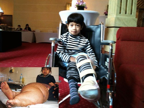 The girl before and after the surgery