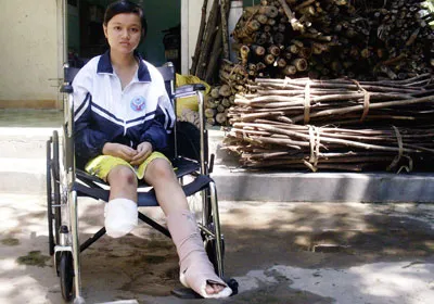 Xin giúp em Thùy được gắn chân giả