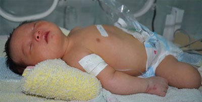 Le Hoang Kim was born without an anus, whom doctors saved in miracle operation (Photo: SGGP)