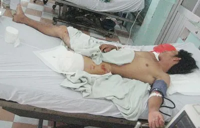 Anh Duy bị cắt bỏ chân trái đến gối