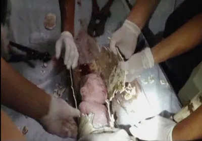 Các bác sĩ cứu đứa bé từ ống nước.