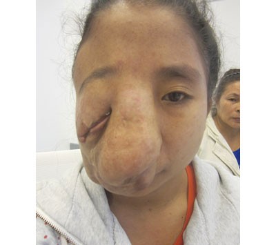 Thien An had a huge tumor on his face (Photo: SGGP)