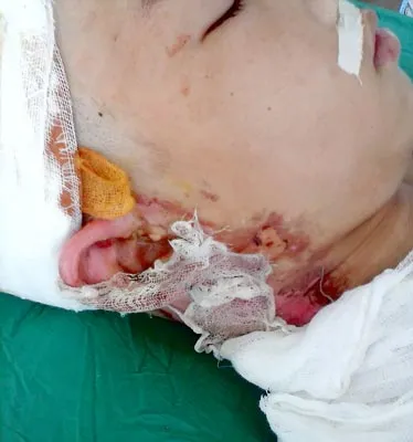 Một học sinh bỏng sọ vì điện cao thế