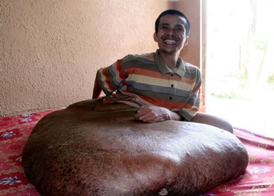 Nguyen Duy Hai before the surgery to remove the giant tumor (Photo: SGGP)