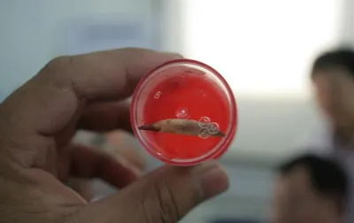 Dị vật ( xương gà ) được lấy ra