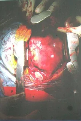 Phẫu thuật thành công khối u nặng 4,5 kg trong ngực bệnh nhân