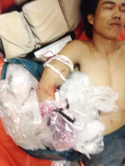 Tàu SAR 274 cứu nạn ngư dân đứt lìa tay trên biển