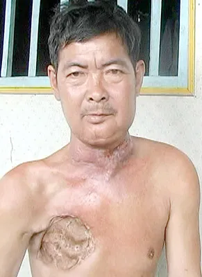 Kiệt quệ vì ung thư